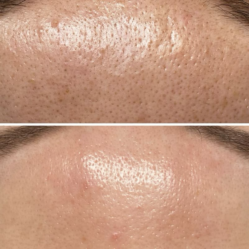 Närbild före och efter Hyaluronic Moisture+ Mist på panna