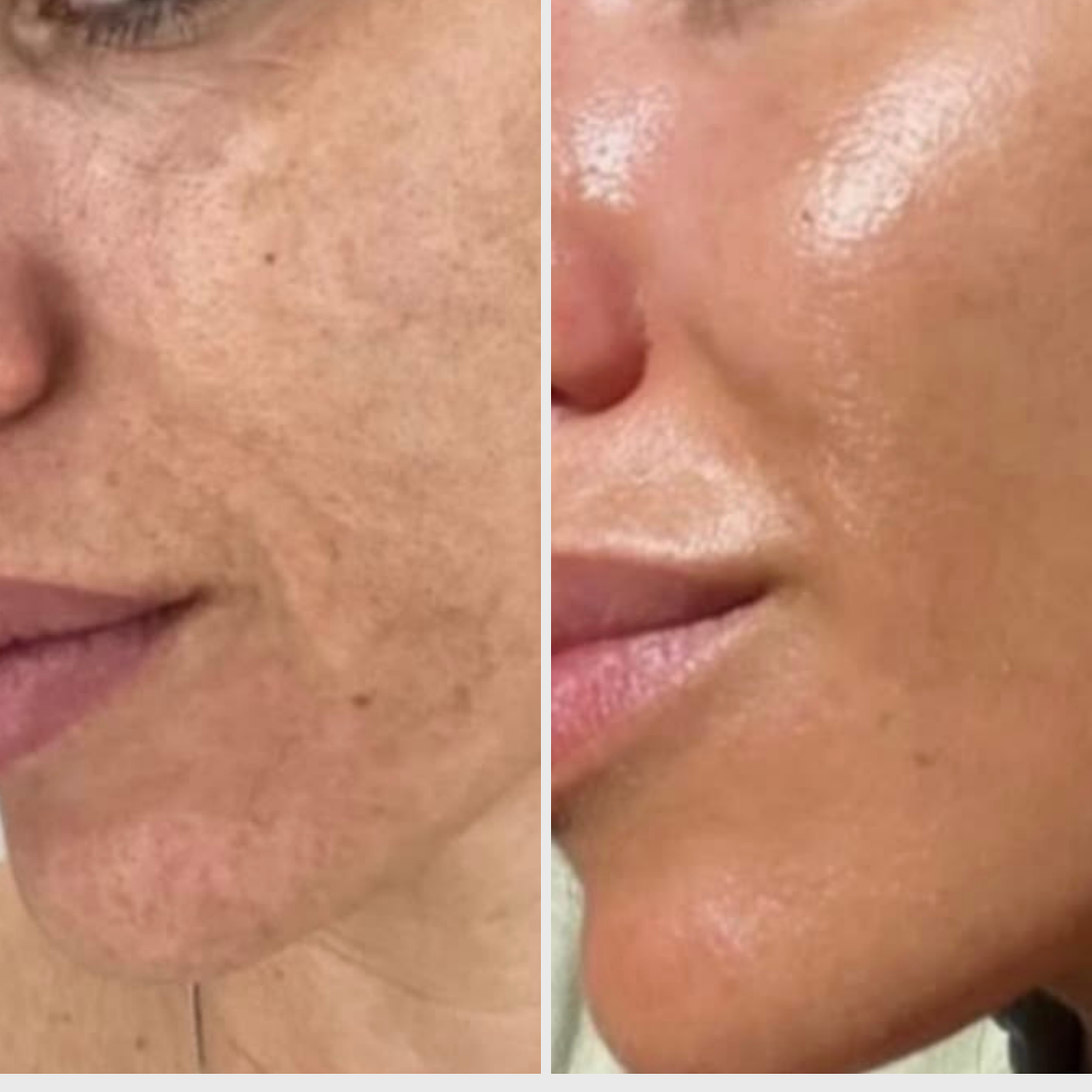 Före och efter användning av Hyaluronic Moisture+ Mist