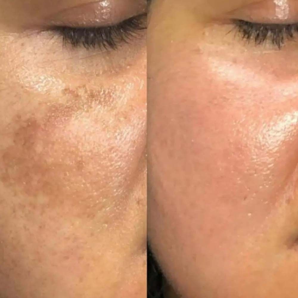 Före och efter användning av Hyaluronic Moisture+ Mist